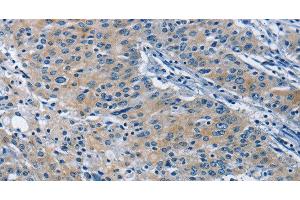 Immunohistochemistry of paraffin-embedded Human gastric cancer tissue using BMPR1B Polyclonal Antibody at dilution 1:30 (BMPR1B 抗体)