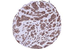 Ileum Neuroendocrine tumor with strong CDH17 immunostaining of all tumor cells CDH17 immunohistochemistry (LI Cadherin 抗体  (AA 242-418))
