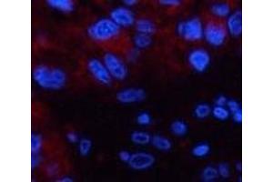 Immunofluorescence analysis of Human liver cancer tissue using CST3 Monoclonal Antibody at dilution of 1:200. (CST3 抗体)