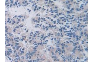 Detection of PALB in Human Prostate cancer Tissue using Polyclonal Antibody to Prealbumin (PALB) (TTR 抗体  (AA 21-147))
