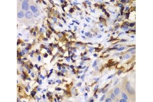 Immunohistochemistry of paraffin-embedded Human liver cancer using HCLS1 Polyclonal Antibody at dilution of 1:100 (40x lens). (HCLS1 抗体)