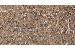 Immunohistochemistry of paraffin-embedded Human prostate cancer tissue using NLRP4 Polyclonal Antibody at dilution 1:40 (NLRP4 抗体)