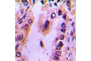 Immunohistochemical analysis of Recoverin staining in human lung cancer formalin fixed paraffin embedded tissue section. (Recoverin 抗体)