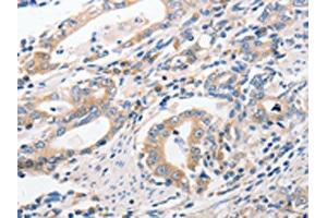 The image on the left is immunohistochemistry of paraffin-embedded Human gastic cancer tissue using ABIN7191756(P2RY11 Antibody) at dilution 1/40, on the right is treated with synthetic peptide.