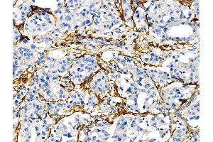 ABIN6265163 and ABIN6272472 at 1/100 staining Human lung cancer by IHC-P.