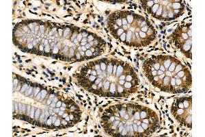 ABIN6256914 and ABIN6274189 at 1/100 staining Human colorectal cancer and adjacent normal tissues by IHC-P.