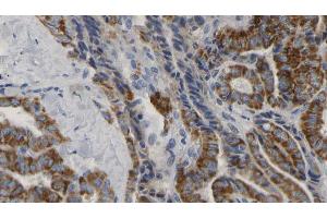 ABIN6267176 at 1/100 staining Human thyroid cancer tissue by IHC-P.