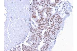 Formalin-fixed, paraffin-embedded human Breast Carcinoma stained with CHD4 Mouse Monoclonal Antibody (3F2/4). (CHD4 抗体  (C-Term))