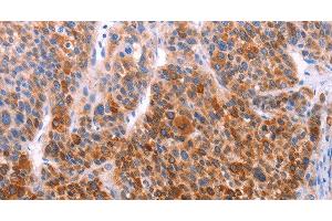 Immunohistochemistry of paraffin-embedded Human liver cancer using AADAC Polyclonal Antibody at dilution of 1:30 (AADAC 抗体)