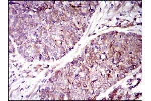 Immunohistochemical analysis of paraffin-embedded esophageal cancer tissues using GUCY1A3 mouse mAb with DAB staining. (GUCY1A1 抗体  (AA 22-214))