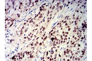 Immunohistochemical analysis of paraffin-embedded bladder cancer tissues using CIRBP mouse mAb with DAB staining. (CIRBP 抗体  (AA 1-90))