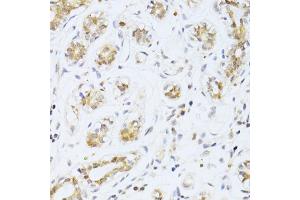 Immunohistochemistry of paraffin-embedded human breast cancer using ETV1 antibody. (ETV1 抗体)