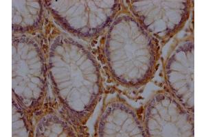 IHC image of ABIN7156171 diluted at 1:200 and staining in paraffin-embedded human colon cancer performed on a Leica BondTM system. (RHBDF2 抗体  (AA 1-200))
