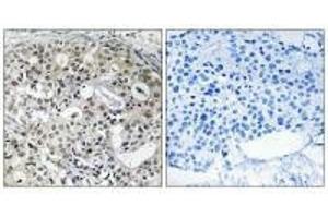 Immunohistochemistry analysis of paraffin-embedded human breast carcinoma tissue using CNTD2 antibody. (CNTD2 抗体)