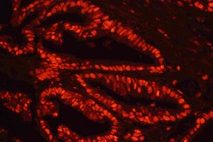 Ki67 was detected in paraffin-embedded sections of human intestinal cancer tissues using rabbit anti- Ki67 Antigen Affinity purified polyclonal antibody (Catalog # PB9026) at 1 ? (Avidin 抗体  (Cy3))
