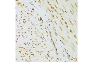 Immunohistochemistry of paraffin-embedded human adenomyosis using HMGB1 Antibody. (HMGB1 抗体  (AA 100-200))