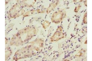 Immunohistochemistry of paraffin-embedded human gastric cancer using ABIN7165283 at dilution of 1:100 (PDIA6 抗体  (AA 20-300))