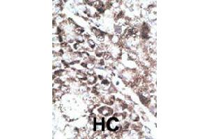 Formalin-fixed and paraffin-embedded human hepatocellular carcinoma tissue reacted with GPR37 polyclonal antibody  , which was peroxidase-conjugated to the secondary antibody, followed by DAB staining . (GPR37 抗体  (C-Term))