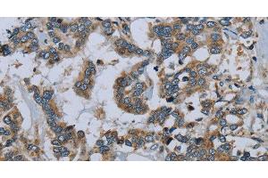 Immunohistochemistry of paraffin-embedded Human liver cancer using PCK2 Polyclonal Antibody at dilution of 1:60 (PEPCK 抗体)