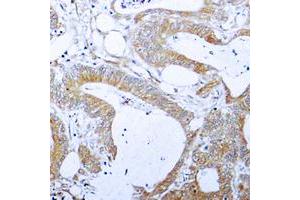 Immunohistochemical analysis of BCLX (pT47) staining in human colon cancer formalin fixed paraffin embedded tissue section. (BCL2L1 抗体  (pSer47))