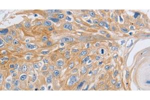 Immunohistochemistry of paraffin-embedded Human esophagus cancer using SLC16A7 Polyclonal Antibody at dilution of 1:30 (SLC16A7 抗体)