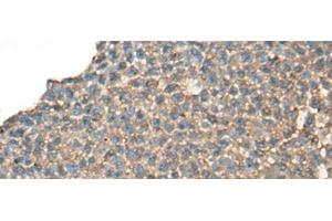 Immunohistochemistry of paraffin-embedded Human ovarian cancer tissue using CABP5 Polyclonal Antibody at dilution of 1:65(x200) (CABP5 抗体)