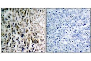 Immunohistochemical analysis of paraffin- embedded human lung carcinoma tissue using Chk2 (phospho-Thr68) antibody (E011061). (CHEK2 抗体  (pThr68))