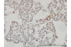 Immunoperoxidase of monoclonal antibody to SESN2 on formalin-fixed paraffin-embedded human ovary, clear cell carcinoma. (Sestrin 2 抗体  (AA 1-480))