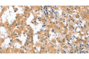 Immunohistochemistry of paraffin-embedded Human thyroid cancer tissue using CDR2 Polyclonal Antibody at dilution 1:60 (CDR2 抗体)