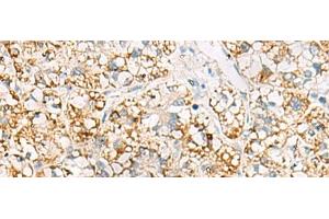 Immunohistochemistry of paraffin-embedded Human liver cancer tissue using MRPL20 Polyclonal Antibody at dilution of 1:60(x200)
