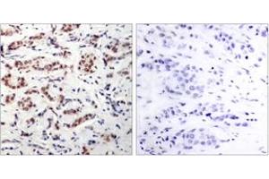 Immunohistochemistry analysis of paraffin-embedded human breast carcinoma, using STAT5A (Phospho-Tyr694) Antibody.