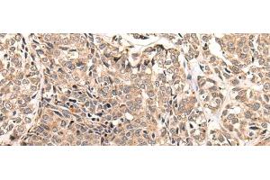 Immunohistochemistry of paraffin-embedded Human esophagus cancer tissue using LDAH Polyclonal Antibody at dilution of 1:55(x200) (LDAH/C2orf43 抗体)