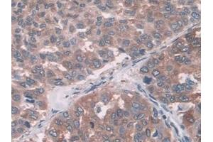 Detection of FUT6 in Human Liver cancer Tissue using Polyclonal Antibody to Fucosyltransferase 6 (FUT6) (FUT6 抗体  (AA 35-359))