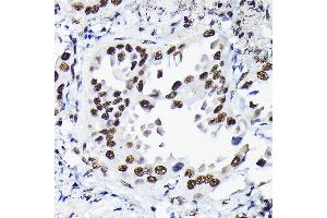 Immunohistochemistry of paraffin-embedded human lung cancer using HDGF Rabbit pAb  at dilution of 1:50 (40x lens). (HDGF 抗体  (AA 1-240))