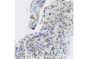 Immunohistochemistry of paraffin-embedded human gastric cancer using CD117/c-Kit antibody (ABIN6133454, ABIN6142896, ABIN6142898 and ABIN6213818) at dilution of 1:150 (40x lens). (KIT 抗体  (AA 25-295))