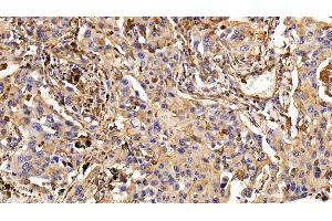 Detection of EGFR in Human Lung cancer Tissue using Monoclonal Antibody to Epidermal Growth Factor Receptor (EGFR) (EGFR 抗体  (AA 888-1210))
