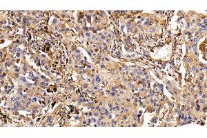 Detection of EGFR in Human Lung cancer Tissue using Monoclonal Antibody to Epidermal Growth Factor Receptor (EGFR)