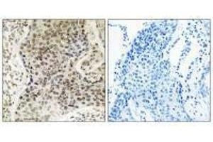 Immunohistochemistry analysis of paraffin-embedded human lung carcinoma tissue, using TSEN54 antibody. (TSEN54 抗体)