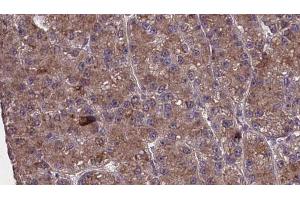 ABIN6273980 at 1/100 staining Human liver cancer tissue by IHC-P. (OR2M4 抗体)