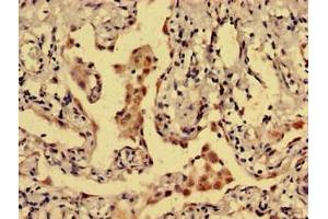 Immunohistochemistry analysis of human lung cancer using ABIN7149466 at dilution of 1:100 (Dopamine Receptor d1 抗体  (AA 338-446))