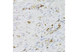 Immunohistochemistry of paraffin-embedded human adenomyosis using LSP1 Antibody (ABIN6130532, ABIN6143368, ABIN6143370 and ABIN6221252) at dilution of 1:100 (40x lens). (LSP1 抗体  (AA 1-339))