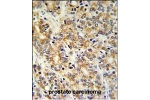 TXNDC12 Antibody (C-term) (ABIN651065 and ABIN2840056) IHC analysis in formalin fixed and paraffin embedded prostate carcinoma followed by peroxidase conjugation of the secondary antibody and DAB staining. (TXNDC12 抗体  (C-Term))