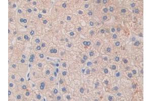 IHC-P analysis of Human Liver cancer Tissue, with DAB staining. (GLDC 抗体  (AA 81-268))