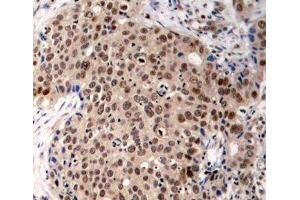 Immunohistochemistry of paraffin-embedded Human breast carcinoma using Phospho-MAPKAPK2(T334) Polyclonal Antibody (MAPKAP Kinase 2 抗体  (pThr334))