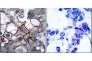 Immunohistochemistry analysis of paraffin-embedded human breast carcinoma, using EGFR (Phospho-Tyr1197) Antibody. (EGFR 抗体  (pTyr1197))