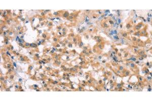 Immunohistochemistry of paraffin-embedded Human thyroid cancer tissue using LATS2 Polyclonal Antibody at dilution 1:30 (LATS2 抗体)