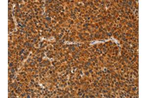 The image on the left is immunohistochemistry of paraffin-embedded Human liver cancer tissue using ABIN7129834(IKZF3 Antibody) at dilution 1/60, on the right is treated with fusion protein. (IKZF3 抗体)