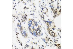 Immunohistochemistry of paraffin-embedded human gastric cancer using TOP1 antibody. (Topoisomerase I 抗体)