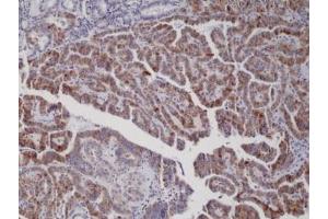 IHC staining of formalin fixed and paraffin embedded thyroid carcinoma tissue with recombinant BRAF V600E antibody. (Recombinant BRAF 抗体  (V600E))