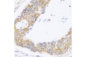 Immunohistochemistry of paraffin-embedded human colon carcinoma using ZAK antibody (ABIN5975284) at dilution of 1/100 (40x lens). (ZAK 抗体)